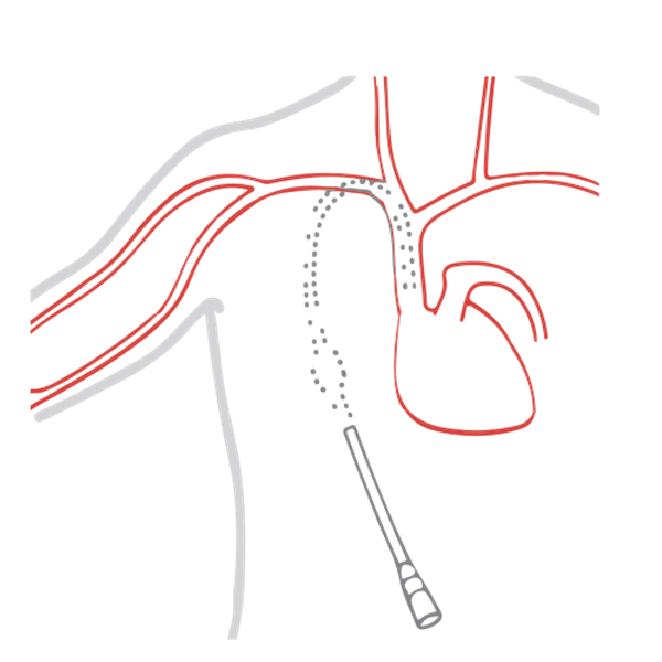 Vascular Access
