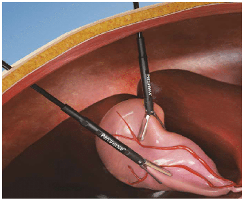 Percuvance Surgical System